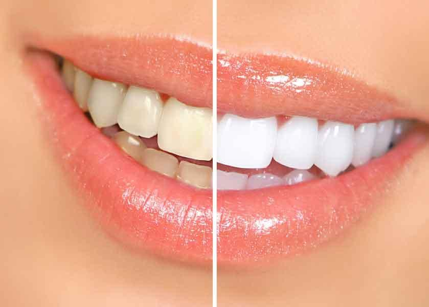 Reasons To Have Your Teeth Whitened by a Dentist